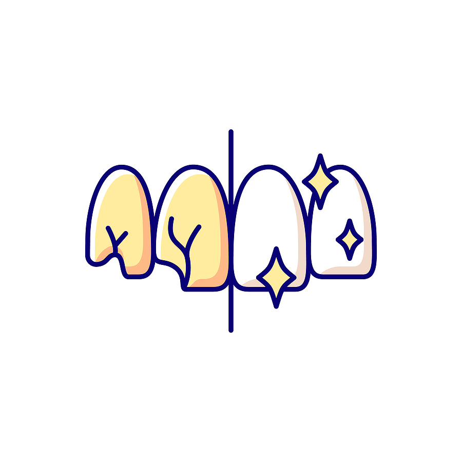 Dental Bonding Dental Bonding